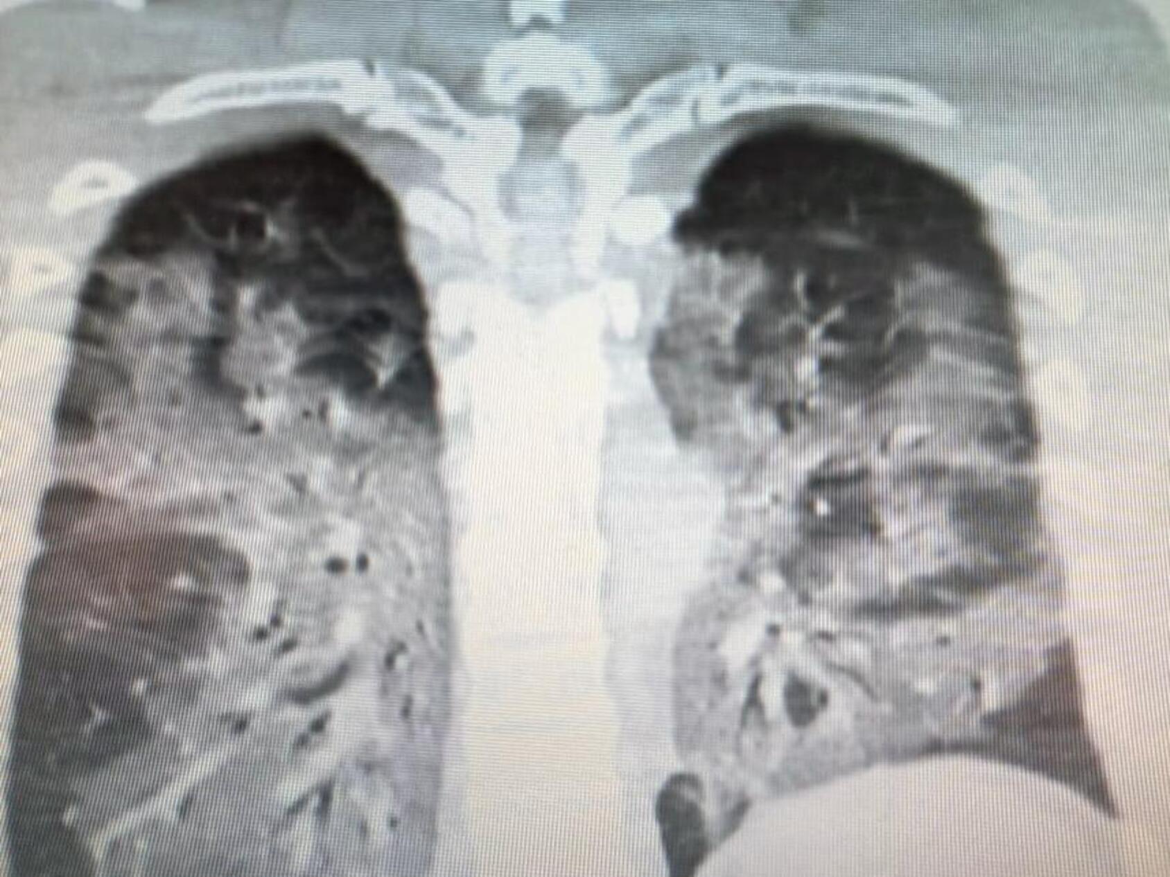 Рентген легких и флюорография: в чем отличие, когда назначают
